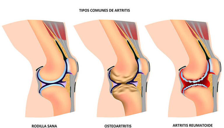 Reumatoide y la Osteoartritis